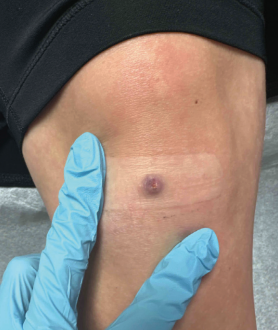 What Is This Pink Papule on the Right Knee?